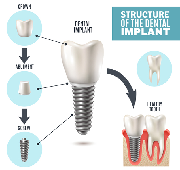 Dental Implants